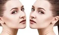 هزینه عمل جراحی بینی در سال 1404 + جدول قیمت