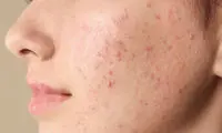 چه بخوریم که جوش نزنیم؟