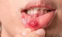 علت آفت مکرر دهان و راه‌های درمان آن چیست؟