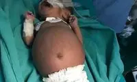تولد نوزادی که در شکمش جنین دوقلوی خود را داشت!