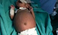 تولد نوزادی که در شکمش جنین دوقلوی خود را داشت!