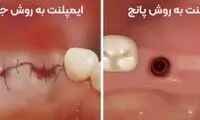 مقایسه ایمپلنت دیجیتال با معمولی