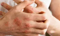 هشدار مهم؛ خطر ریزگردها برای پوست و مو 