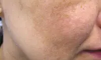نحوه از بین‌بردن لک‌های صورت چگونه است؟