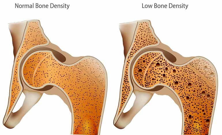 حفظ تراکم استخوان با یک راهکار ساده!