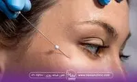 بهترین نوع نخ برای لیفت صورت چیست؟