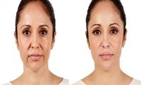 تزریق فیلر خط خنده در تهران + قیمت سال 1404