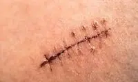 اختراع جالبی که جایگزین بخیه شد!