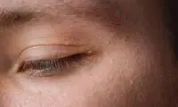 تصویری ترسناک از چشم مبتلا به ویروس HPV!