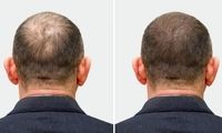 تاثیر سلول های بنیادی بر ریزش مو