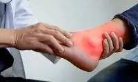 نقرس چه زمانی رخ می‌دهد؟