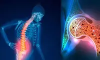 افزایش پوکی استخوان با خوردن این نوشیدنی