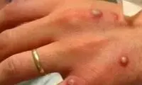 بیماری خطرناکی که پس از کرونا در کمین ماست