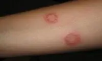 زنگ خطر شیوع بیماری سالک در این شهر به صدا درآمد