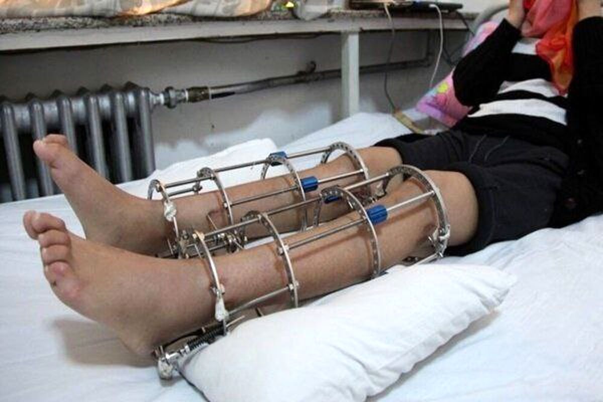   همه‌چیز درباره جراحی افزایش قد 