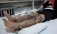 همه‌چیز درباره جراحی افزایش قد