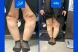 درمان پای پرانتزی بدون جراحی در کلینیک فنی آتل