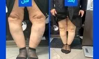 درمان پای پرانتزی بدون جراحی در کلینیک فنی آتل