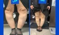 درمان پای پرانتزی بدون جراحی در کلینیک فنی آتل