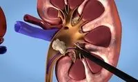 شاید باورتان نشود، این سنگ از کلیه یک بیمار خارج شده