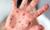 زنگ خطر شیوع بیماری کشنده در یزد