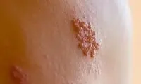زونا چیست و چه علائم و عوارضی دارد؟