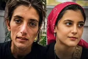تصاویر دلگرم‌کننده از نارین، دختر سنندجی پس از درمان