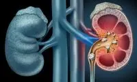 چند توصیه برای پیشگیری از سنگ کلیه در تابستان
