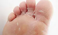 پاهایتان بی‌دلیل پوسته می‌دهند؟ این علت‌ها را جدی بگیرید