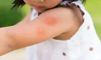 این علائم بعد از نیش حشرات در کودکان زنگ خطرند