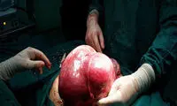 خارج کردن توده 5 کیلویی از شکم بیمار