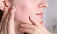محصولات محبوب ضد آکنه و خطر ابتلا به سرطان