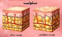 سلولیت چیست و چگونه می‌توان آن را درمان کرد؟