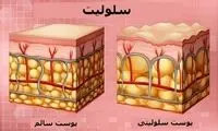 سلولیت چیست و چگونه می‌توان آن را درمان کرد؟