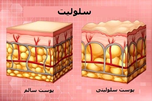 سلولیت چیست و چگونه می‌توان آن را درمان کرد؟