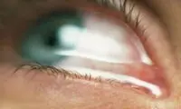 توصیه‌ برای حساسیت‌های چشمی در بهار