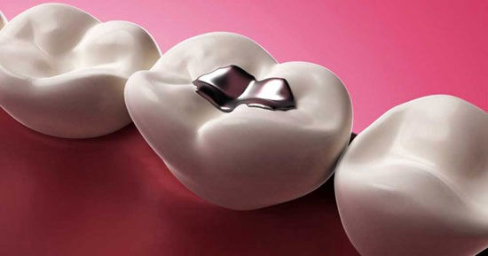 داروی آلزایمر جایگزین پر کردن مصنوعی دندان ها