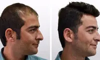 کاشت مو بدون جراحی و هزینه آن