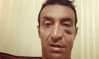 گونه و فک عنایتی شکست