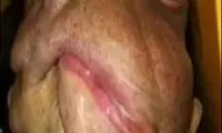 تصاویری از جدیدترین پیوند کامل صورت