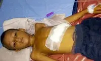 وجود جنین دوقلو در بدن یک پسر بچه