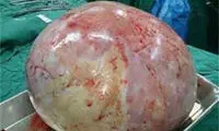 خارج کردن توده 4.5کیلویی از شکم بانوی 18ساله