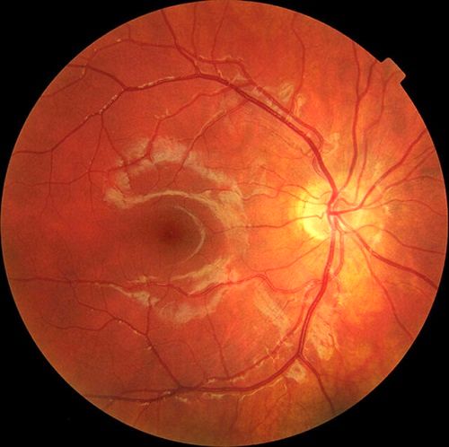 این ژن، کلید درمان یک بیماری نادر چشمی است