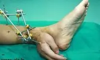 پیوند باورنکردنی دست به مچ پا! +عکس