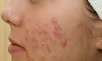 جای جوش را چگونه از بین ببریم؟