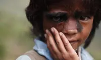 دختر غول‌ نما جراحی شد +عکس