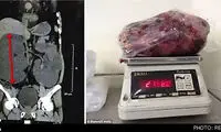 مرد هندی با غول‌آساترین کلیه‌ دنیا! +عکس