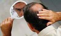 علت افزایش ریزش ارثی مو در تابستان
