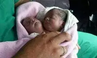 تولد نوزاد 2 سر در سوریه