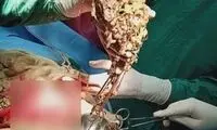 خارج‌کردنِ ۱.۶ کیلوگرم جواهرات از شکمِ زن هندی